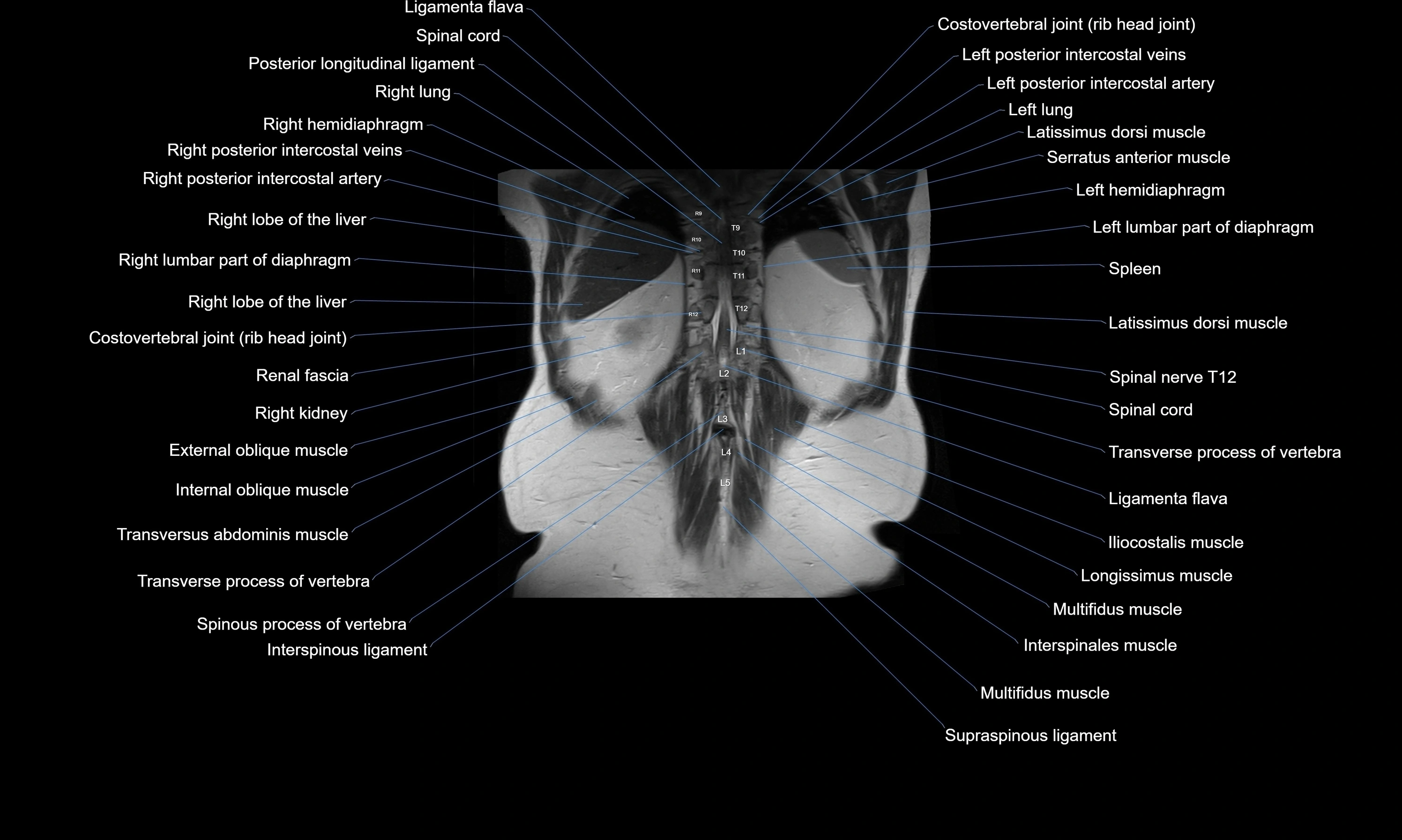 MRI Abdomen axial cross sectional anatomy radiology  image-img-00001-00049.webp